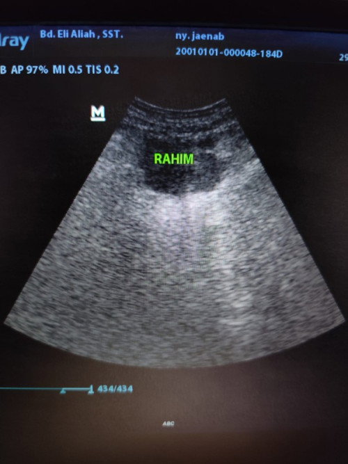 Penebalan dinding rahim usia 10week