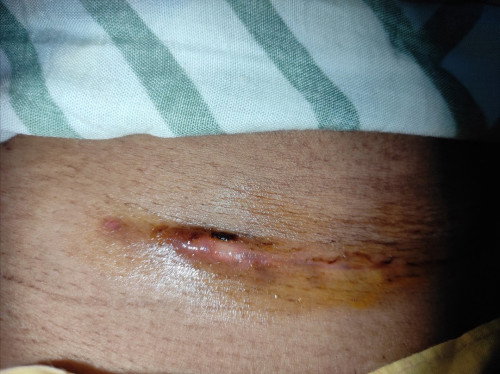 bund mau tanya kalo jahitan sc setelah 3 mg seperti ini normal ngga ya?