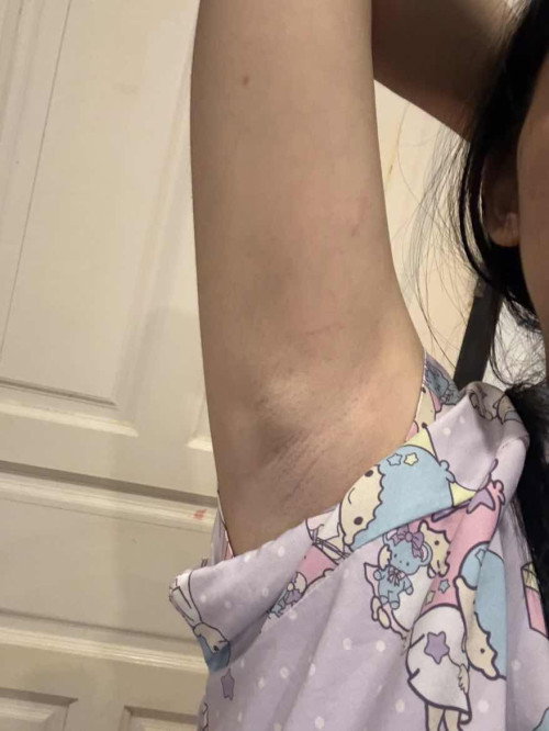 มีแม่บ้านไหนรักแร้บวมข้างเดียวขณะตั้งครรภ์ไหมคะ