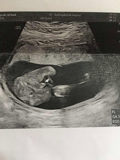 อัลตราซาวด์เพศ