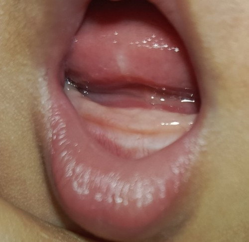 Gusi bengkak bukan ya