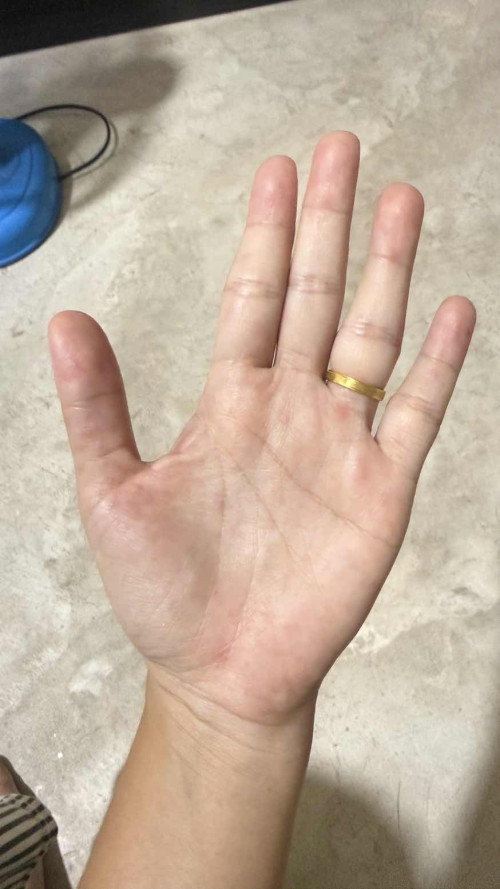 ตั้งครรภ์แล้วตุ่มแดงขึ้นแบบนี้บ้างค่ะ  เจ็บบวกคัน ทั้งมือและเท้าเลยค่ะ