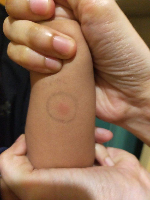 Di diagnosa TB pada usia 8 bulan