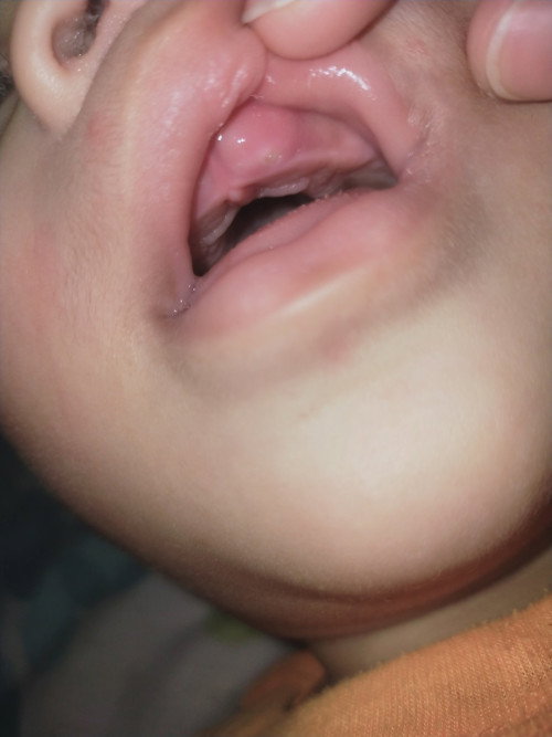 เหงือกน้องเป็นเเบบนี้ ฟันจะขึ้นหรือเหงือกน้องเป็นเเผลคะเเม่ๆ
