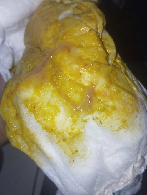 BB anak seret dan terkena disentri