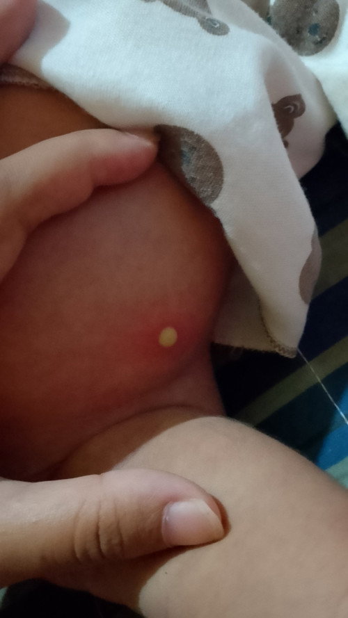 Bayi 21 hari ku timbul ini di bagian perutnya, gimana ya Bund cara nyembuhin nya? Ada yang tau gak ?