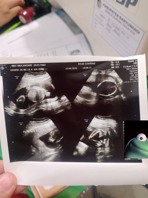 usg 2× usia 20minggu