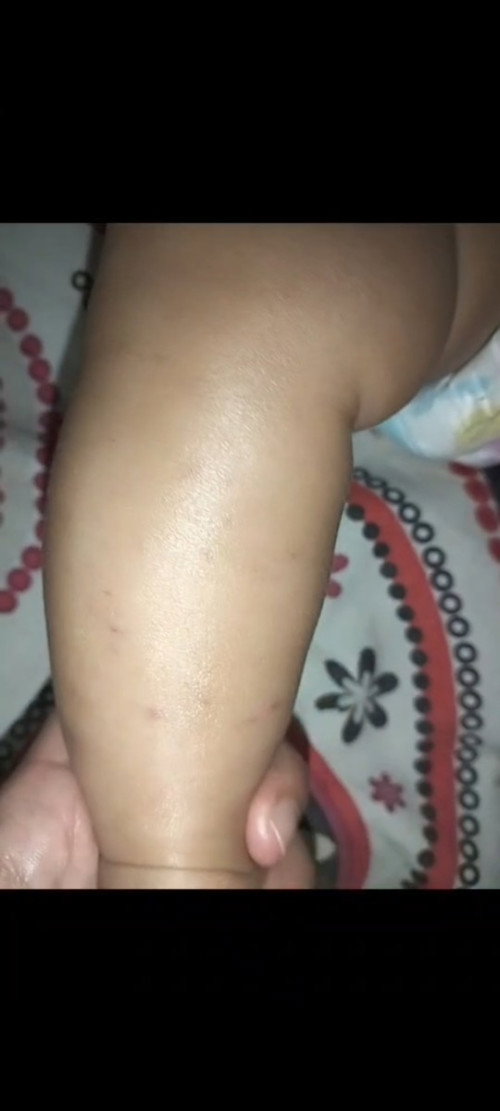 Tiba tiba muncul ruam merah agak keunguan tiba tiba tiba tanpa demam