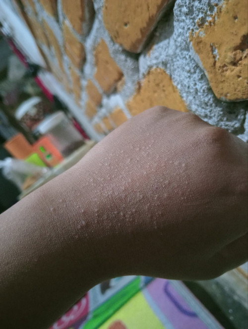 Hamil 13 Minggu tapi muncul beruntusan gatel2 hilang timbul kenapa ya 🥹?