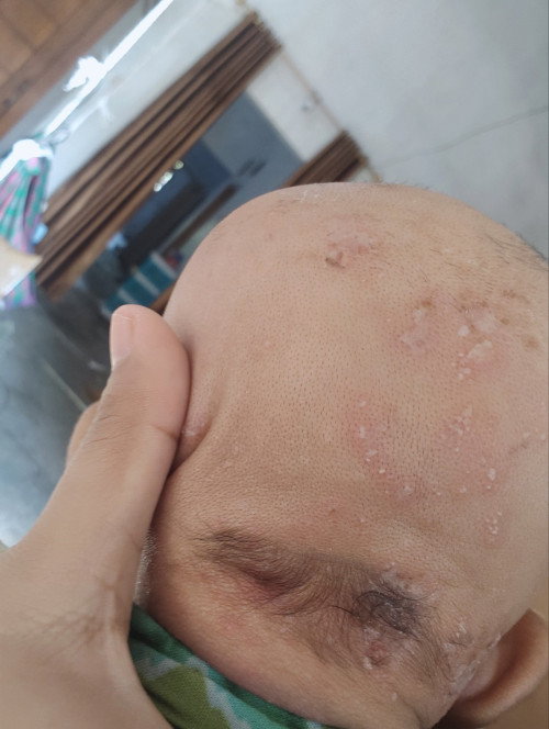 Herpes pda bayi 1bulan