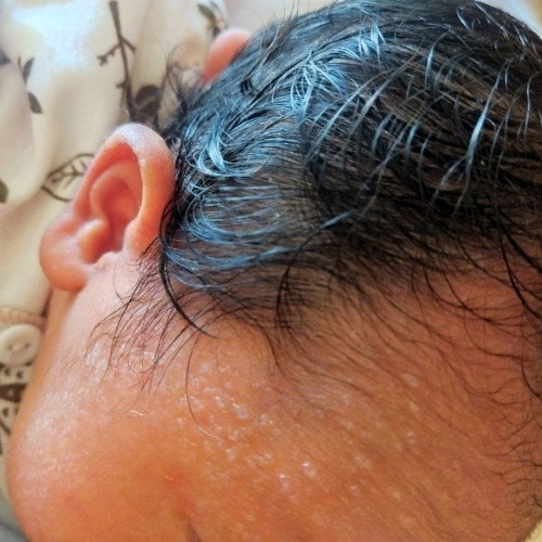 ruam/iritasi bayi