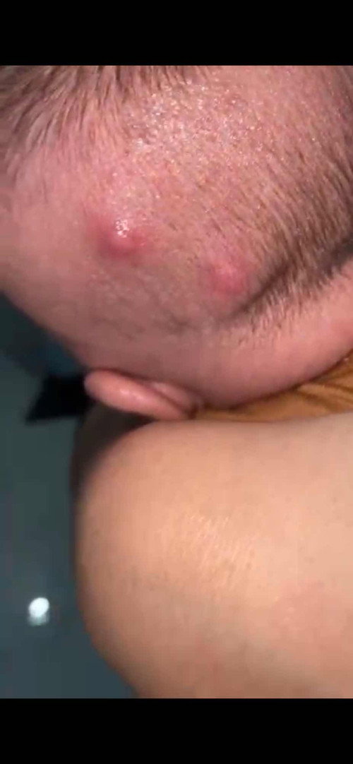 Muncul jerawat dikepala bayi