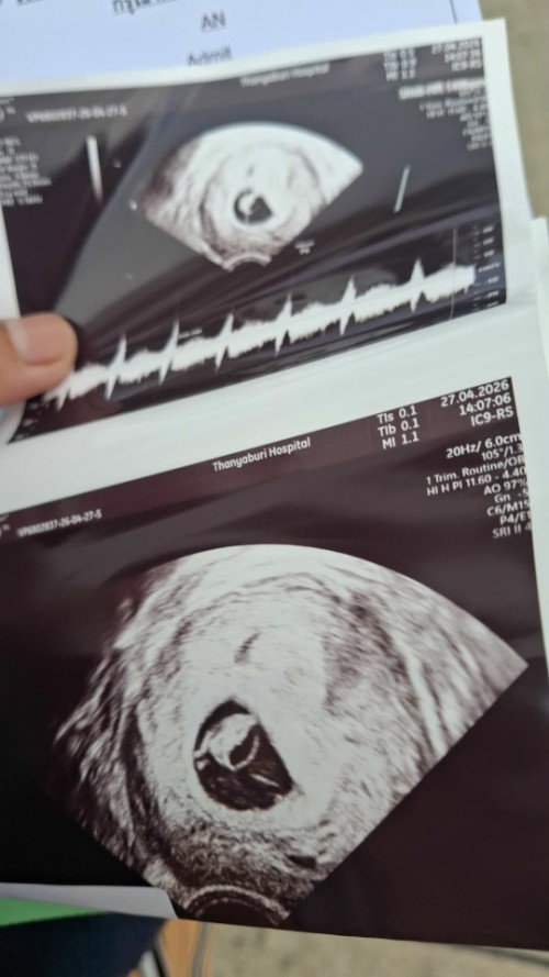 🥰🤪ท้องแรก