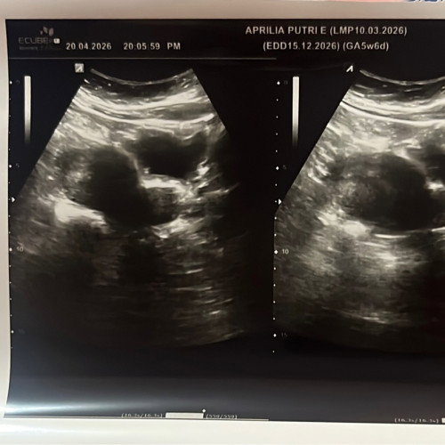 6week blm ada kantong di USG