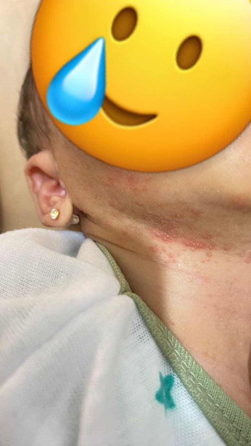 Ruam di leher dan wajah