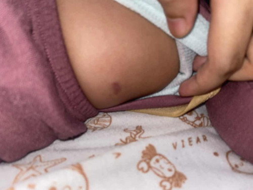 Benjolan di dada dan pinggang bayi