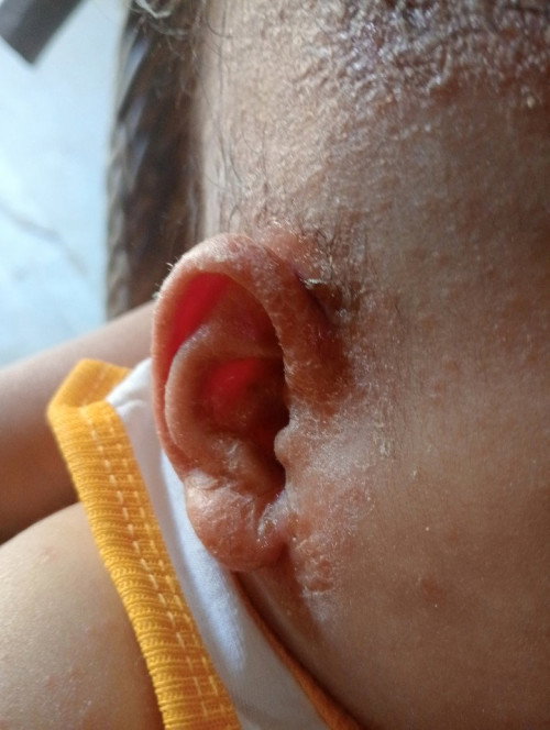 How to treat this po...my baby has a cradle cap and eczema.