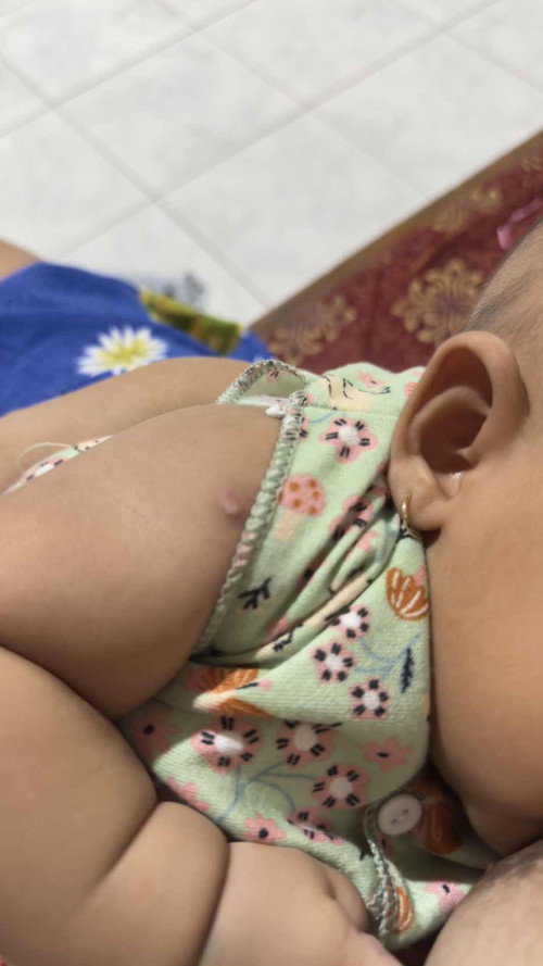 Bekas suntikan bcg