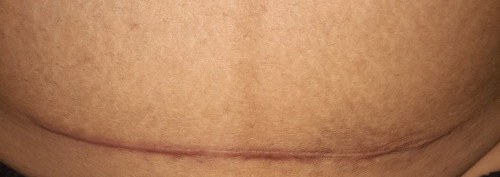 keloid sc