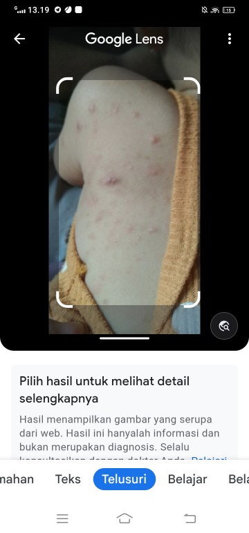Bintik2uh mau 1bulan blm sembuh