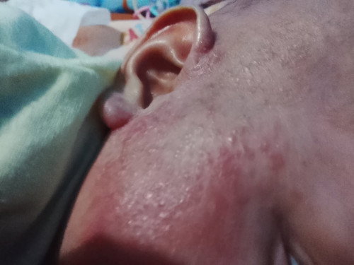 Pipi bayi bnyak bintik merah dan berair jadi ruam gt