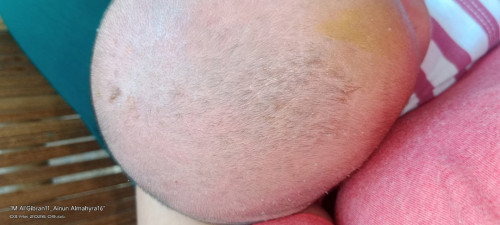 cradle cap!