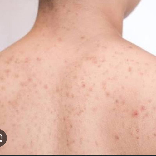 bintik merah blkg badan