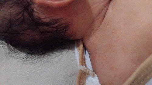 ruam kemerahan di badan