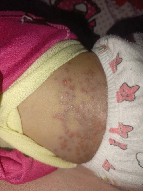 Hallo kak ada yg pernah ngalamin ini ga ya anak nya harus di kasih salep apa kasian bngt udh semingg