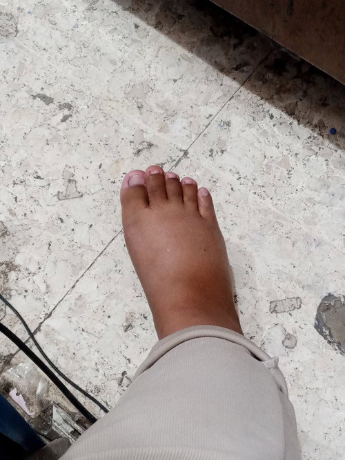 Halo bunda² mau tanya apakah normal kaki bengkak saat hamil 36week? Ada yg ngalamin sama juga ga ya?