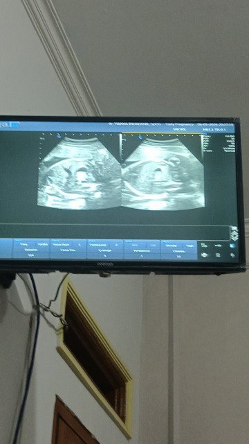 28 week Mau USG 4D gak bisa karna muka a ketutupan plasenta dan Letak bayi nya SUNGSANG
