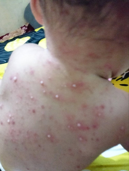 Gatal gatal seperti alergi atau biang keringat ?