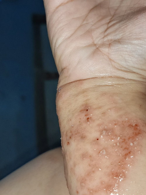 Tambah parah gatal ditangan tm 2
Kira2 ad yg ngalamin gini ndk bun
Obat yg ampuh apa😿
