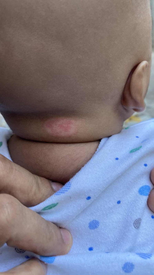 Lingkaran di kulit kepala bayi