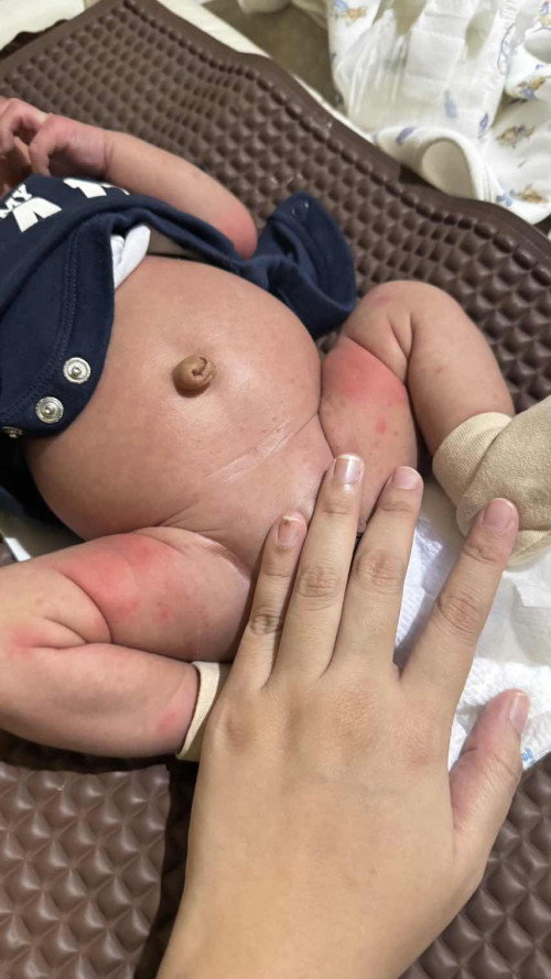 nak tanya dekat bdn baby ada ruam merah dkt peha dgn tangan dia , krim apa ye sesuai untuk hilangkan
