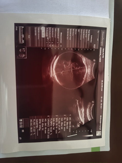 Bayi besar apa bisa lahiran normal