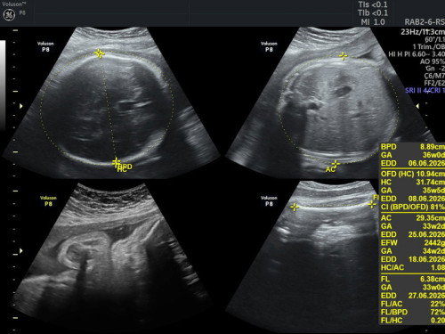 TB dan BB janin bayi 33minggu