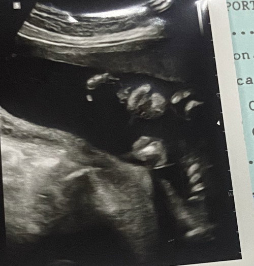 สวัสดีคะพอดีหนูลังเลว่าลูกหนูจะปากแหว่งรึป่าวคะพี่ๆช่วยดูหน่อยคะแบบนี้ปกติไหมคะ🥹🥹🥹
