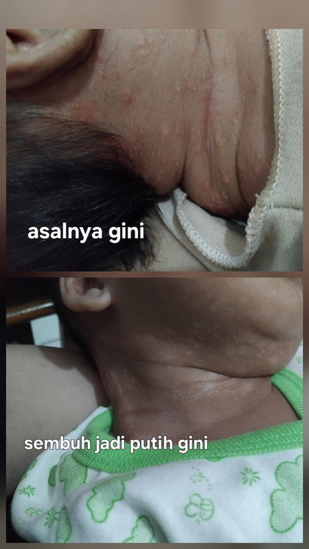 Hilang ga yah bekasnya?