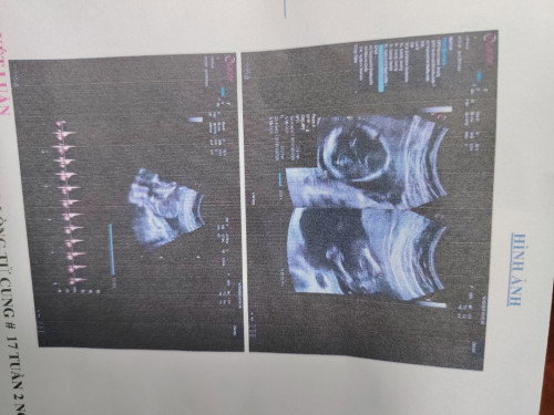 Có ai như tui không
Lúc 14tuan đi sa bs nói là con trai. Chỉ mình con ciu nó. Và mình thấy rất rõ