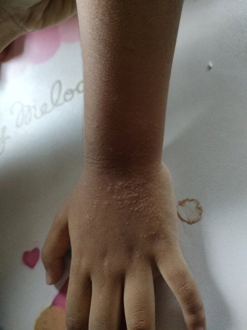 Muncul bintik bintik seperti ini karena apa ya bun?