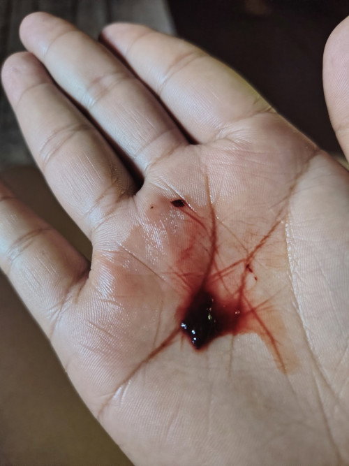2month pregnant. Dinudogo Piro kunti lang patak patak lang po at hinde masakit ang pus on ko