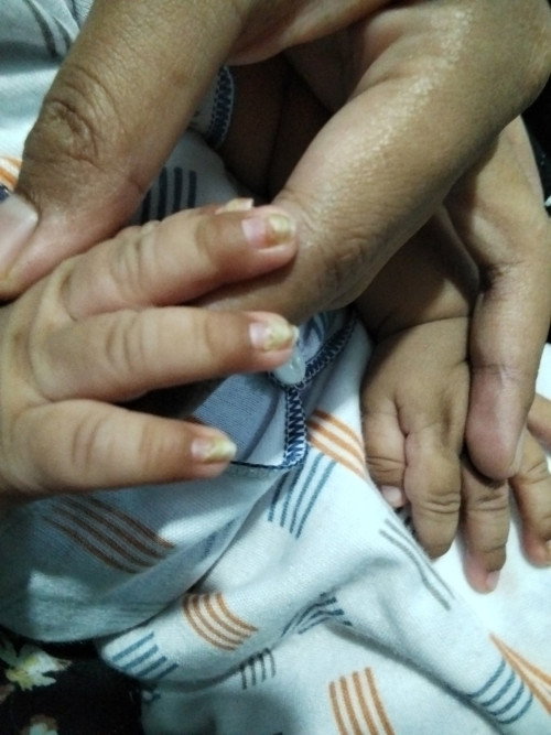 Mau tanya bunda" ada yg pernah ngalamin gk kuku nya kuning dan rapuh