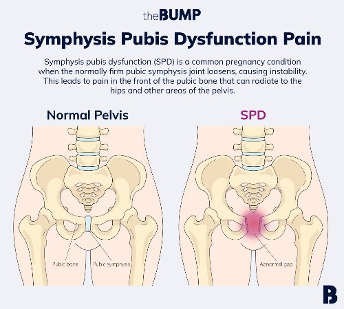 SPD PAIN. Sakit belah kaki kiri.