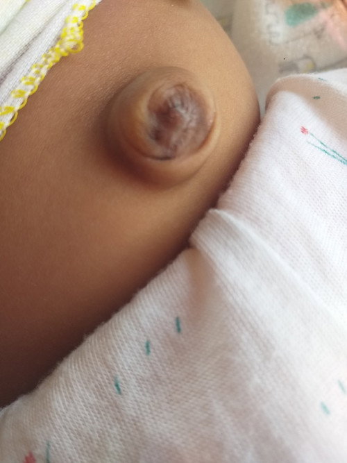 Pusar bodong seperti ini apa bisa normal gak ya, dan gimana caranya?  sekarang bayiku usia 1 bulan..