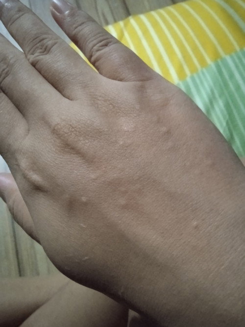 Gatal gatal