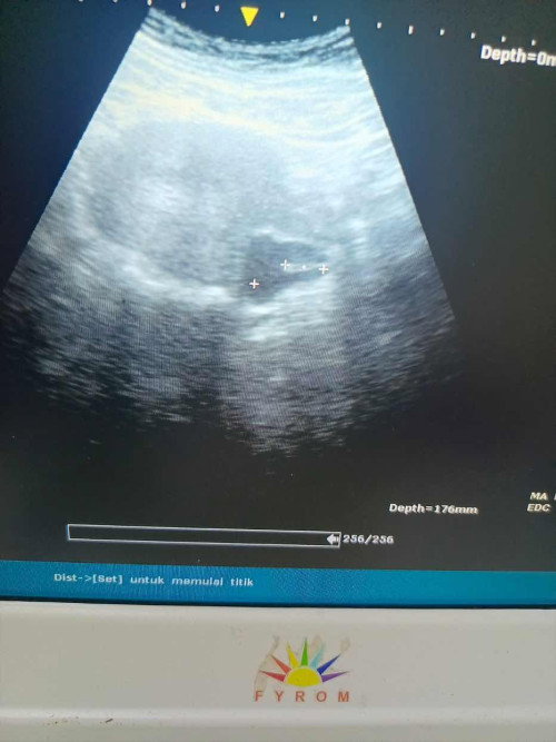 Hamil 8 week keluar darah campur lendir padahl pas usg janin kantong smuanya aman aja