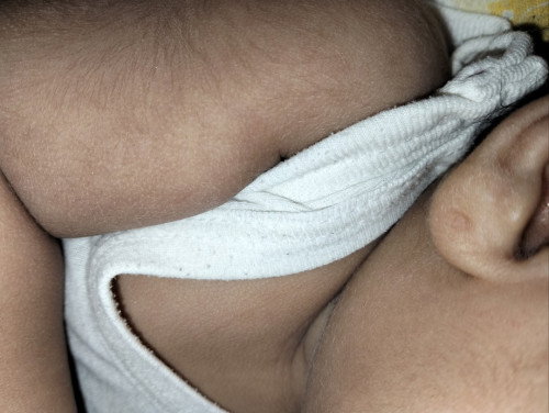 Bekas tindik bayi yang sudah tertutup tapi ada benjolan