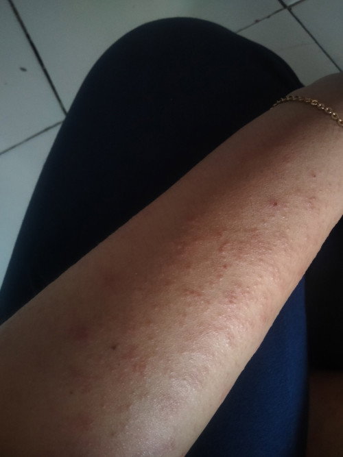 Ada yang pernah mengalami ruam/gatal selama kehamilan kaya gini ? Share pengalamannya dong bun 🙏🏻