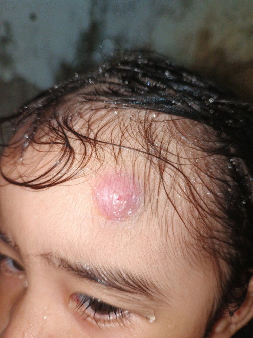 Tanong lang po ano po kaya itong nasa noo ng  anak ko malambot po siya na parang bukol